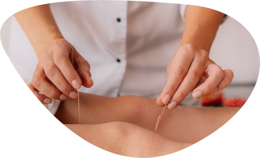 Une praticienne ptratiquant l'acupuncture